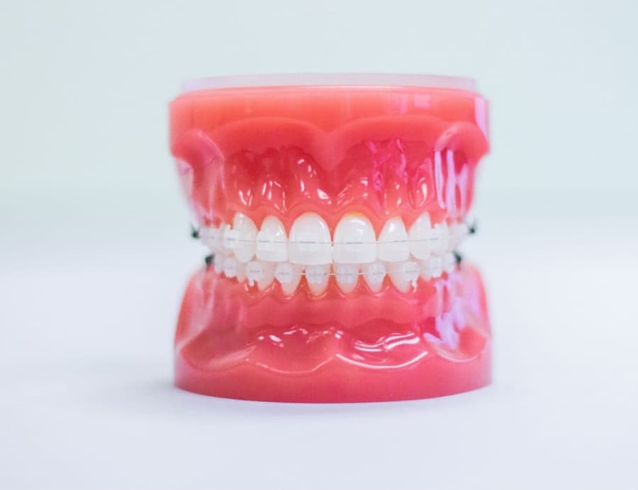 clear braces on plastic model