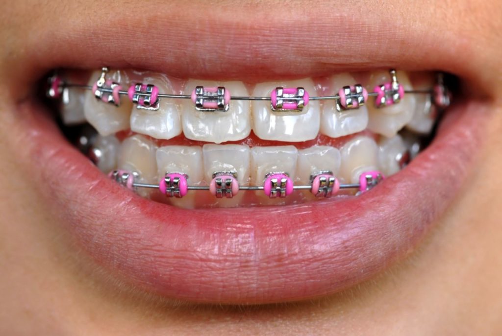 teen with pink braces