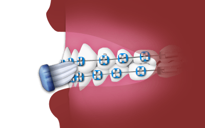 brushing teeth diagram