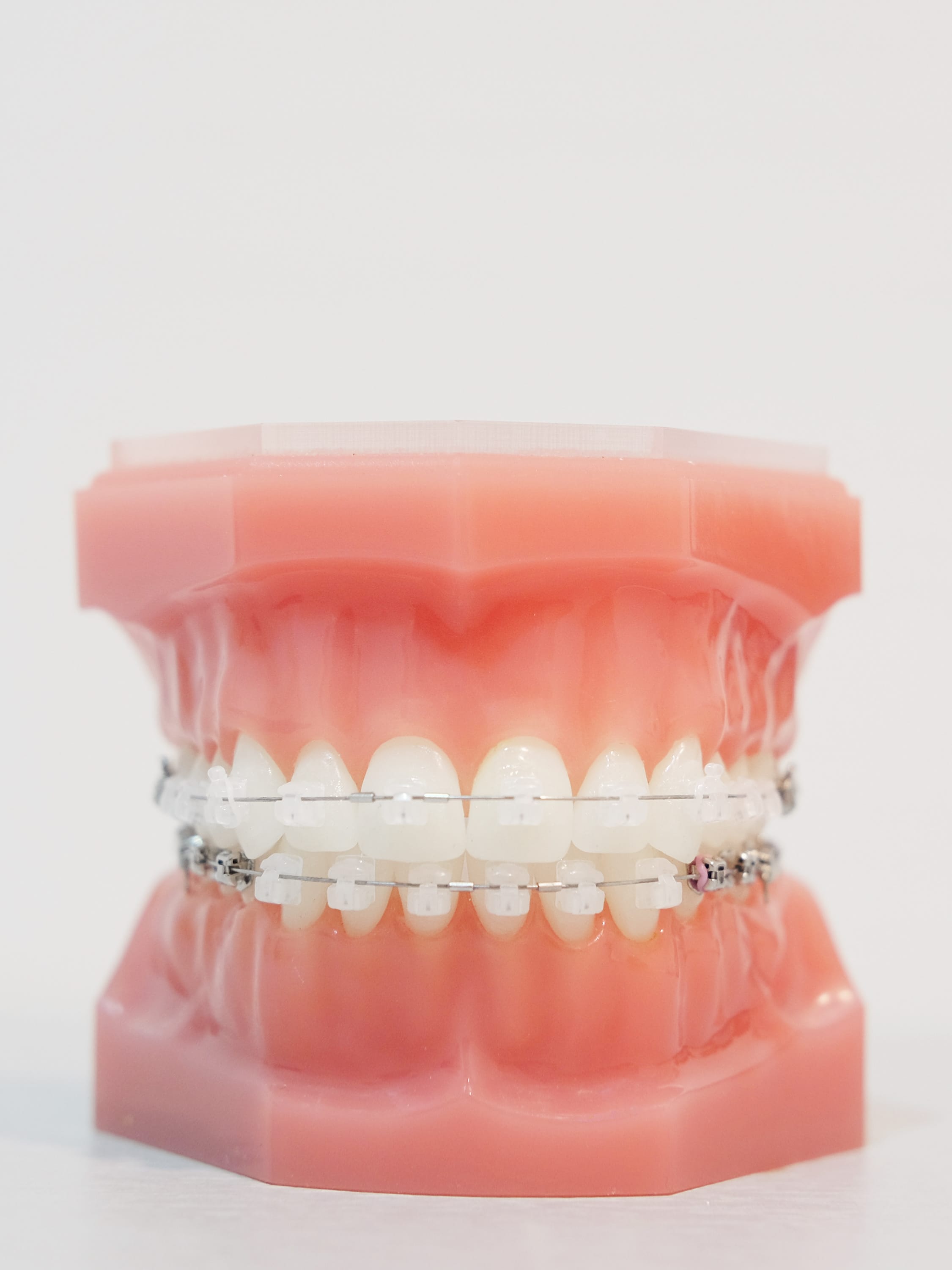 ceramicbracesmodel Booth Orthodontics