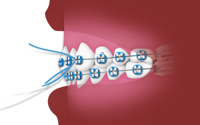 flossing with braces diagram