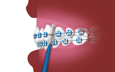 interdental toothbrush diagram