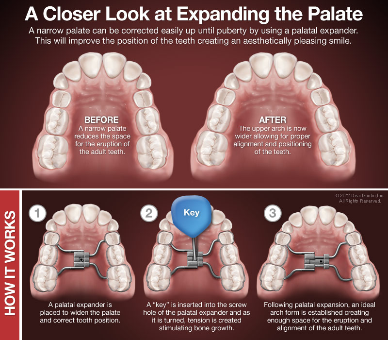 palatal expanders diagram