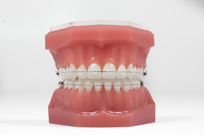 Ceramic Clear Braces