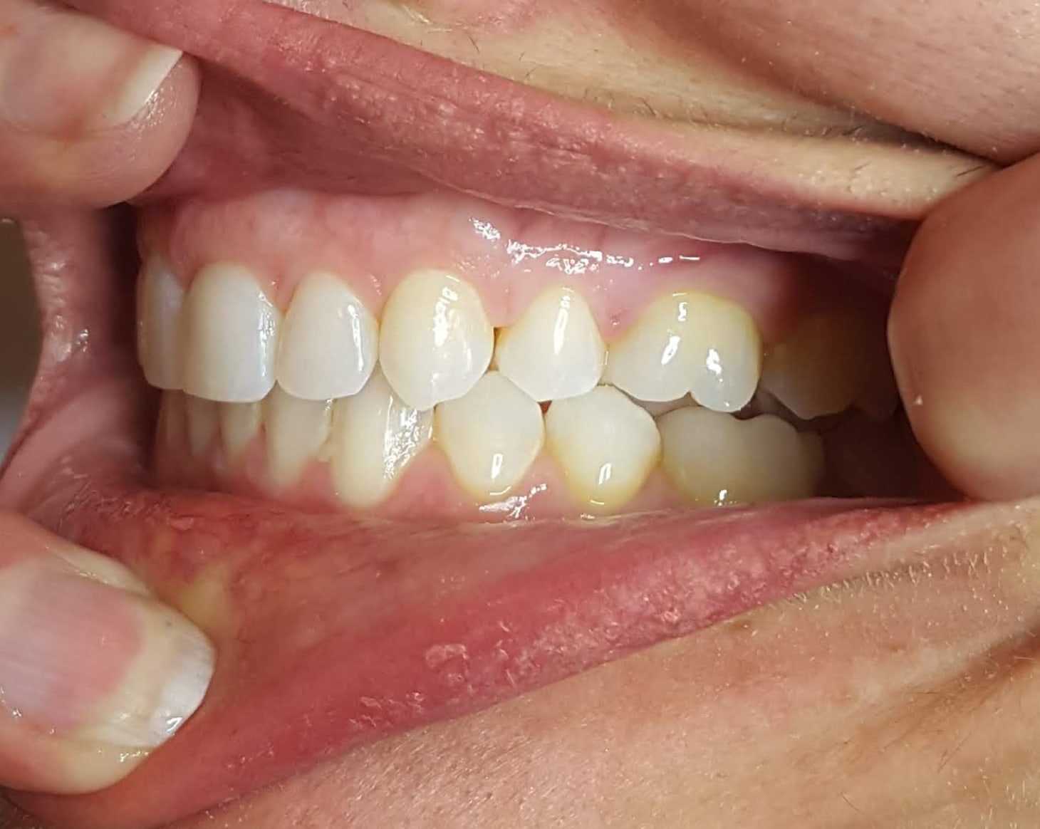 Using two fingers in the front to hold the lips away from the teeth and one finger in the back and take to photo angled to show the left back teeth
