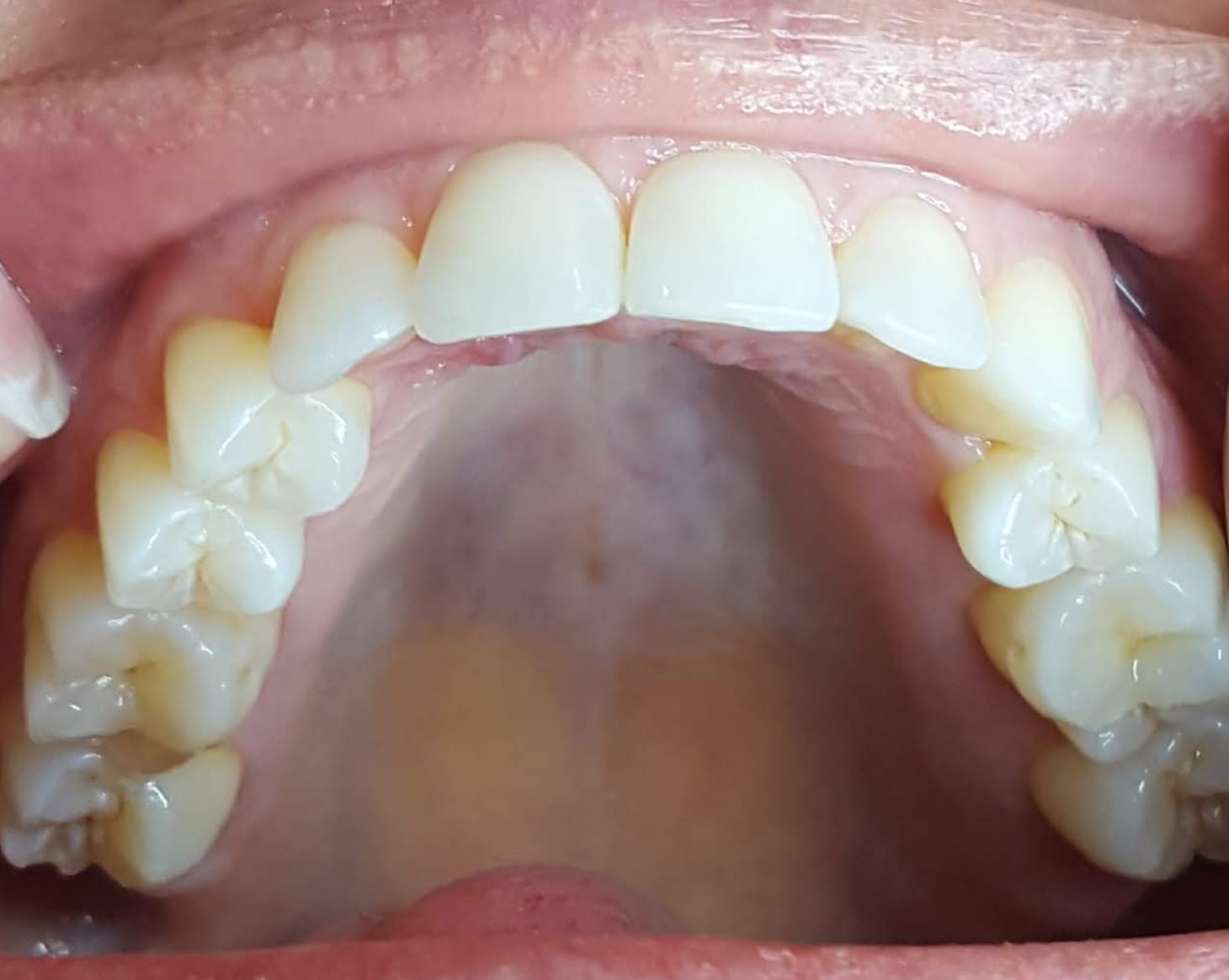 virtual-consult-4 Use two fingers to pull the upper lip up while opening wide and take a photo from the top of the upper teeth