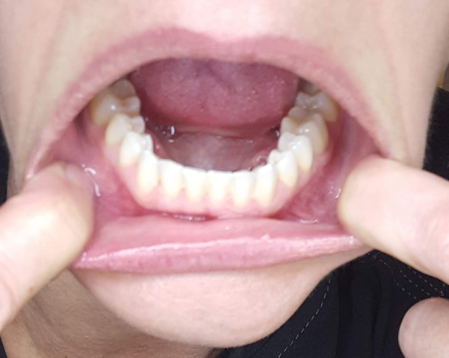 teeth photo front