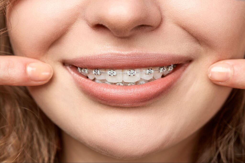 The Best Type Of Braces For Adults